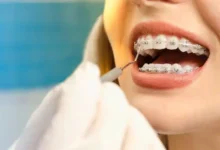 Why Orthodontic Treatment Is Crucial for Long-Term Dental Health